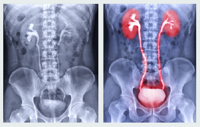 Blood vessel model for contrast medium - Accessories - X-ray